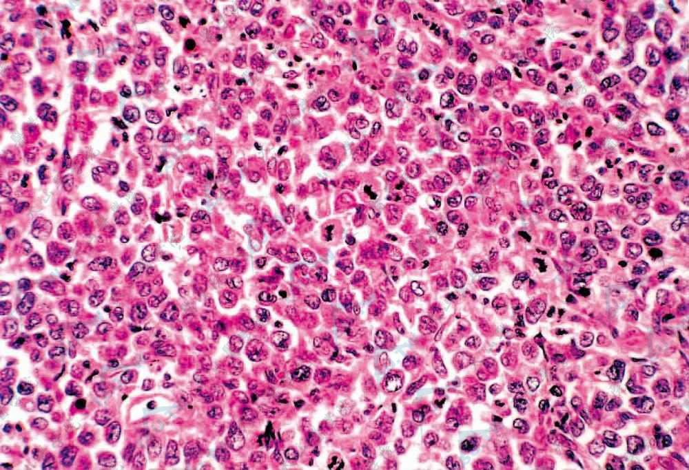 瘤细胞大、胞质丰富，细胞核大，有较多核分裂象（HE染色×400）