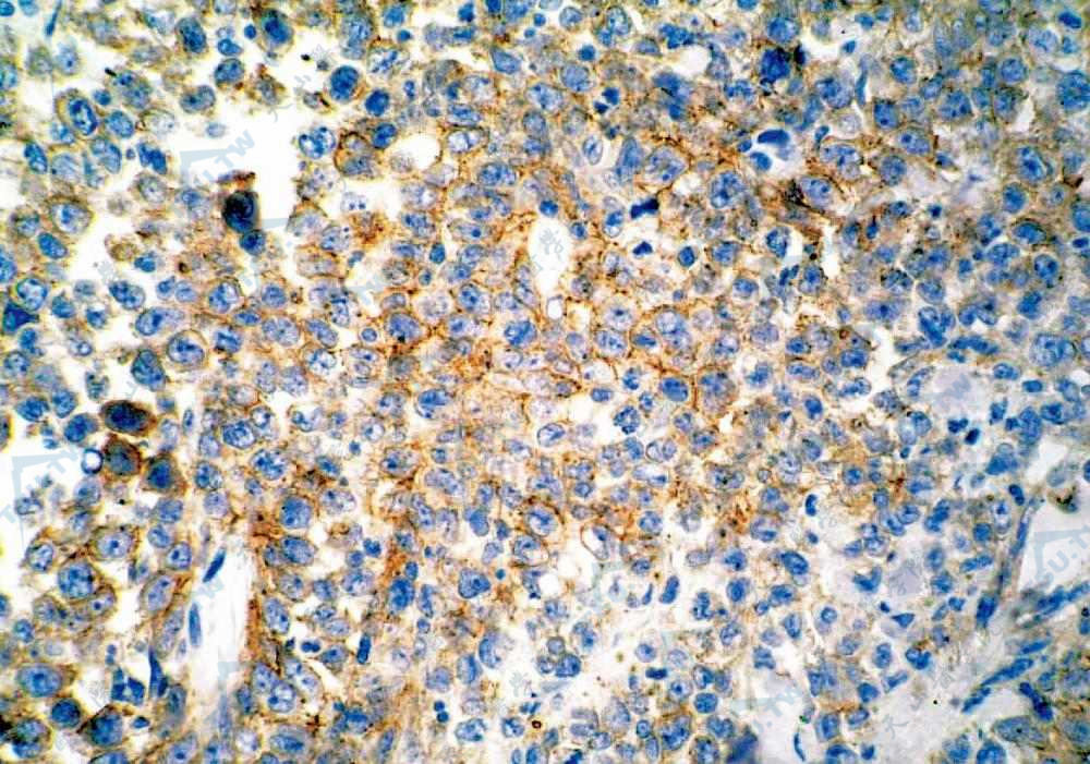 约70％瘤细胞CD30阳性（IHC染色×400）