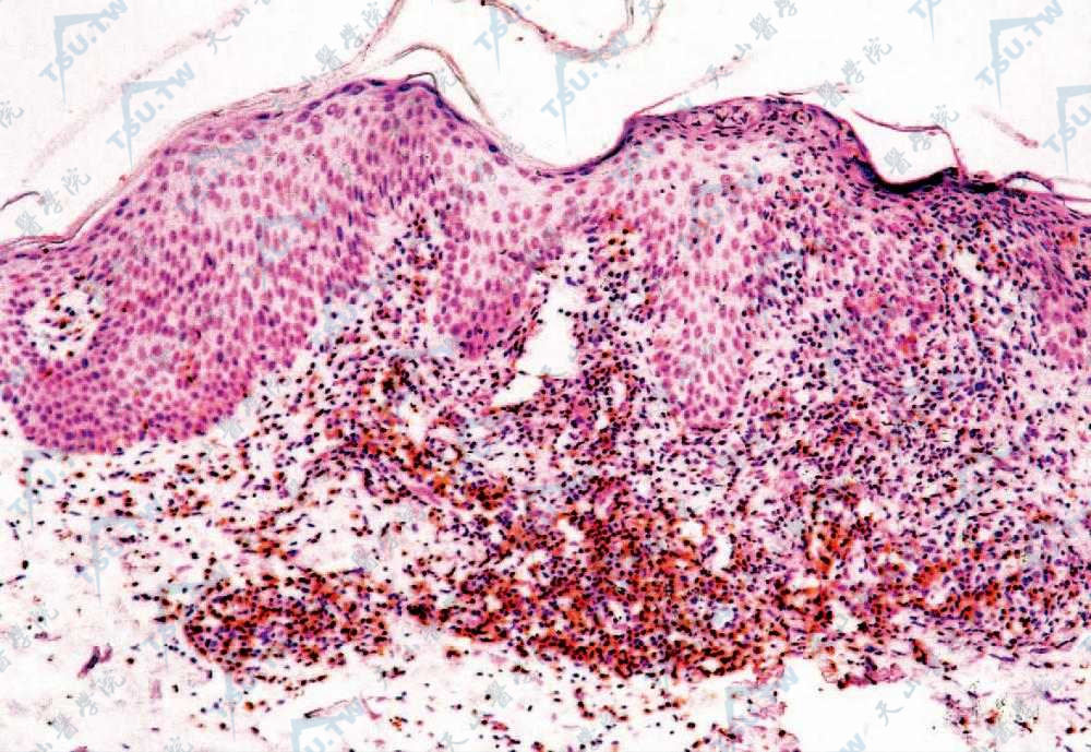 CD45Ro细胞胞质阳性（SP法×100）