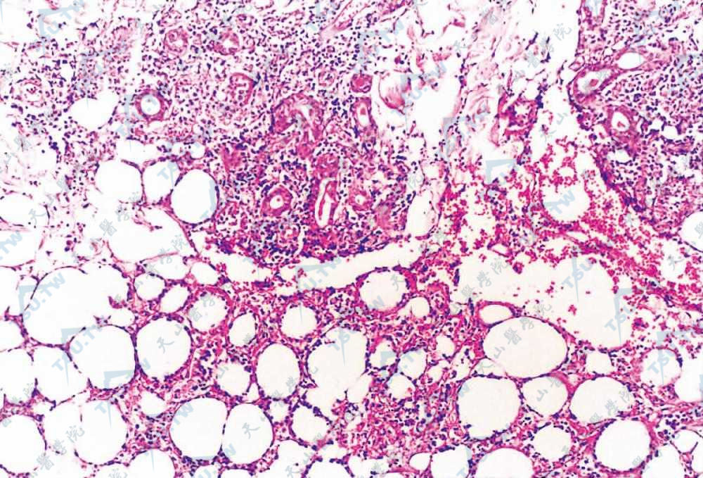 脂肪细胞周围淋巴细胞呈环状排列（HE染色×100）