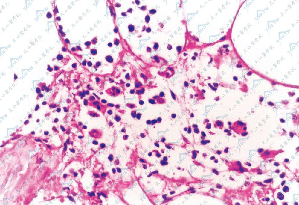 脂肪细胞间有较多吞噬细胞及异形淋巴细胞（HE染色×200）