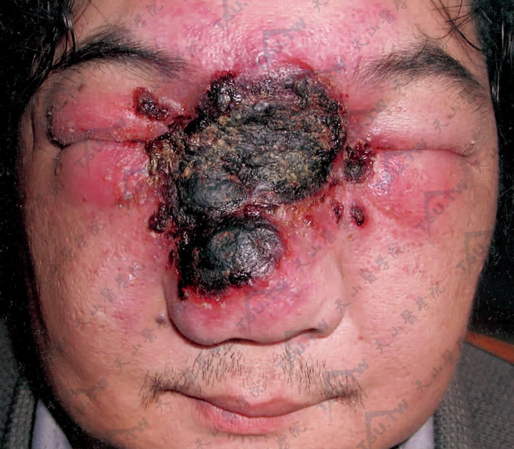 结外NK/T细胞淋巴瘤（鼻型）患者鼻子溃烂