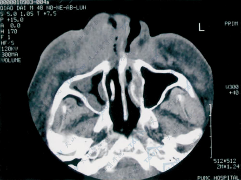 结外NK/T细胞淋巴瘤（鼻型）鼻窦CT示右鼻腔前部及右上颌窦内软组织影，未见骨质破坏