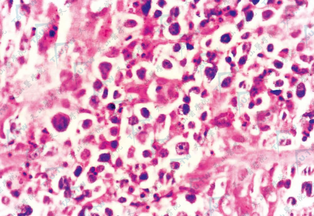 瘤细胞形态大小不一，核深染，周围有透明晕（HE染色×400）