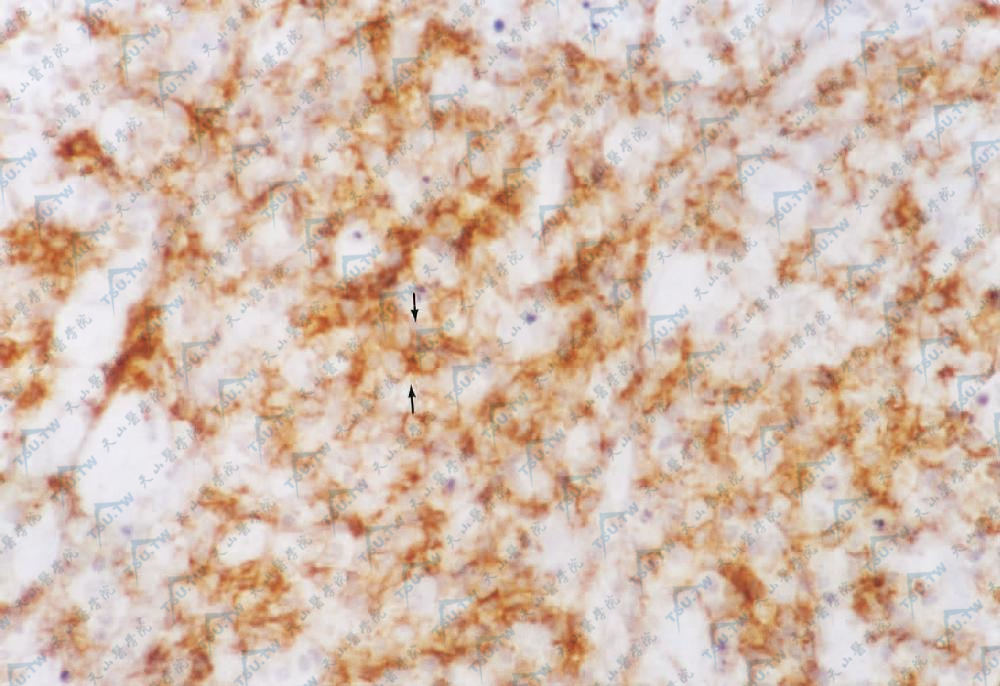 箭头所指是CD56阳性细胞灶，阳性为棕黄色，颗粒位于胞膜（SP法×200）