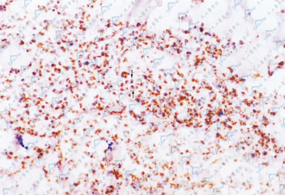 箭头所指是TIA-1阳性细胞，阳性物质为棕黄色颗粒，位于胞质（SP法×200）