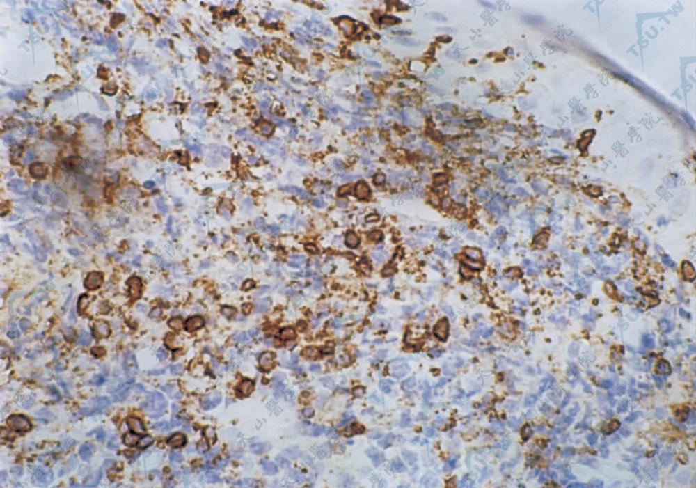肿瘤细胞呈UCHL-1膜阳性反应（SP法×400）