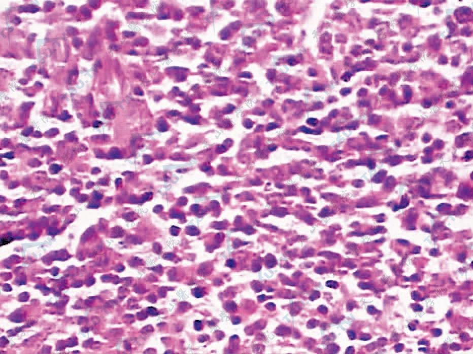 以小淋巴细胞为主的炎细胞浸润（HE染色×400）