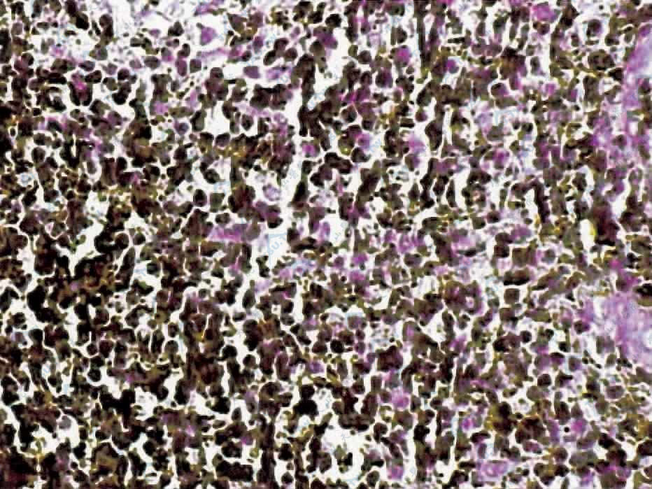 真皮内浸润细胞CD45RA强阳性表达（SP法×400）