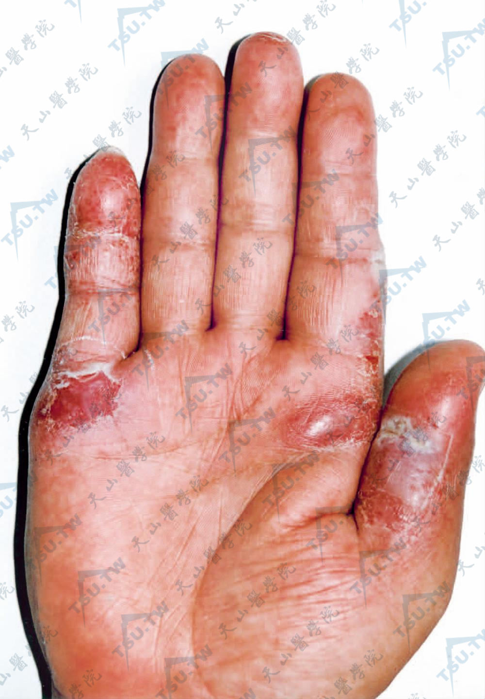 右手掌可见浸润性红斑，部分红斑表面糜烂，结痂