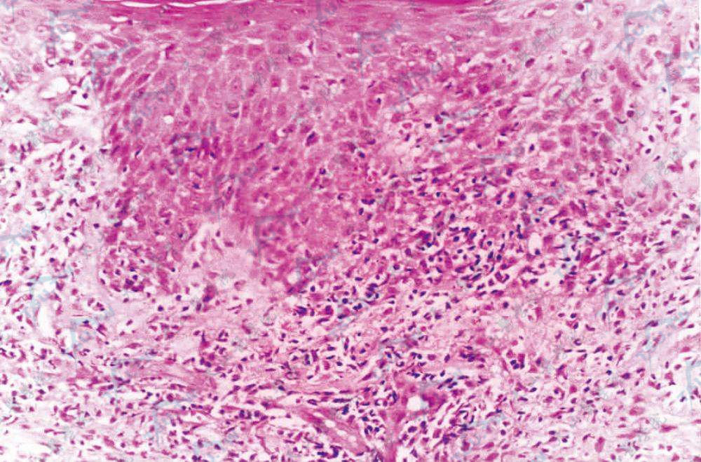 真皮中上部可见弥漫性不典型单一核肿瘤细胞浸润