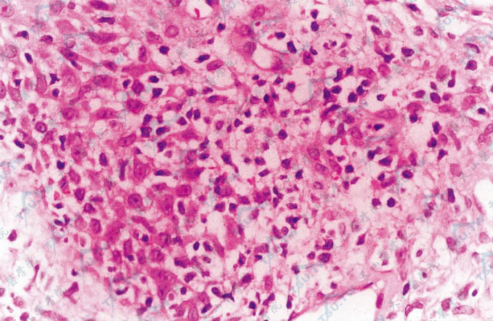 肿瘤细胞核较大，部分细胞可见明显核仁，细胞有明显的异型性