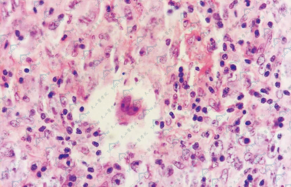 中央双核瘤巨细胞（Reed-Sternberg细胞）（HE染色×400）