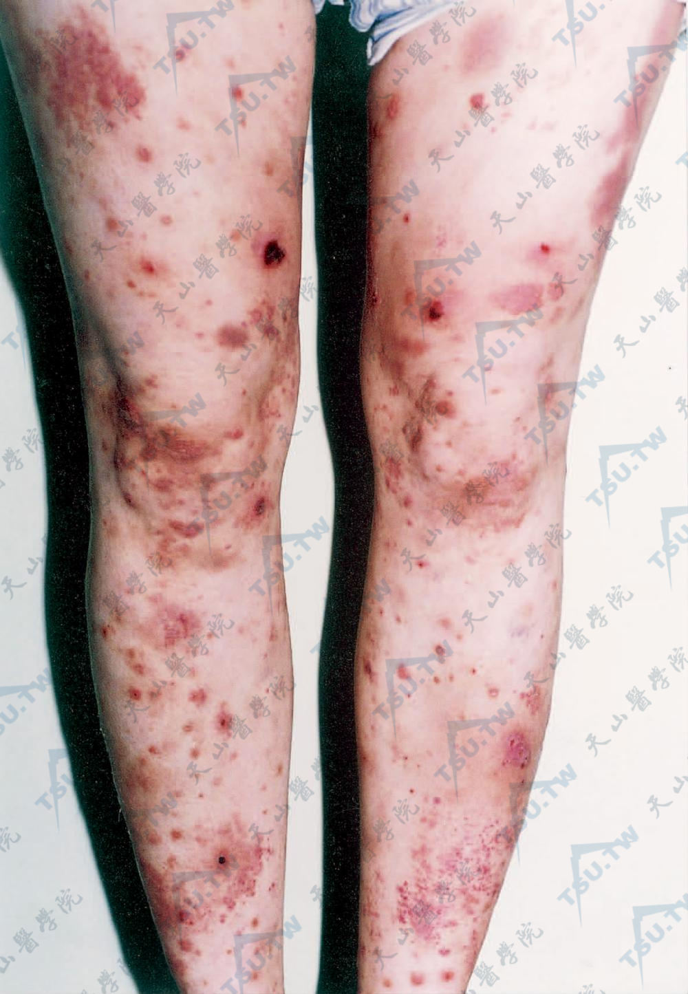 皮肤白血病症状：双下肢伸侧皮疹，可见散在分布的丘疹，紫癜，结节