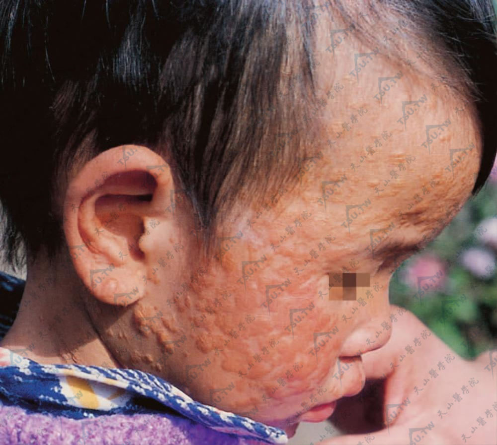 皮疹表现为黄红色色素性斑丘疹，圆形或卵圆形，不规则形斑丘疹或小结节，在斑丘疹上摩擦或划痕能引起风团