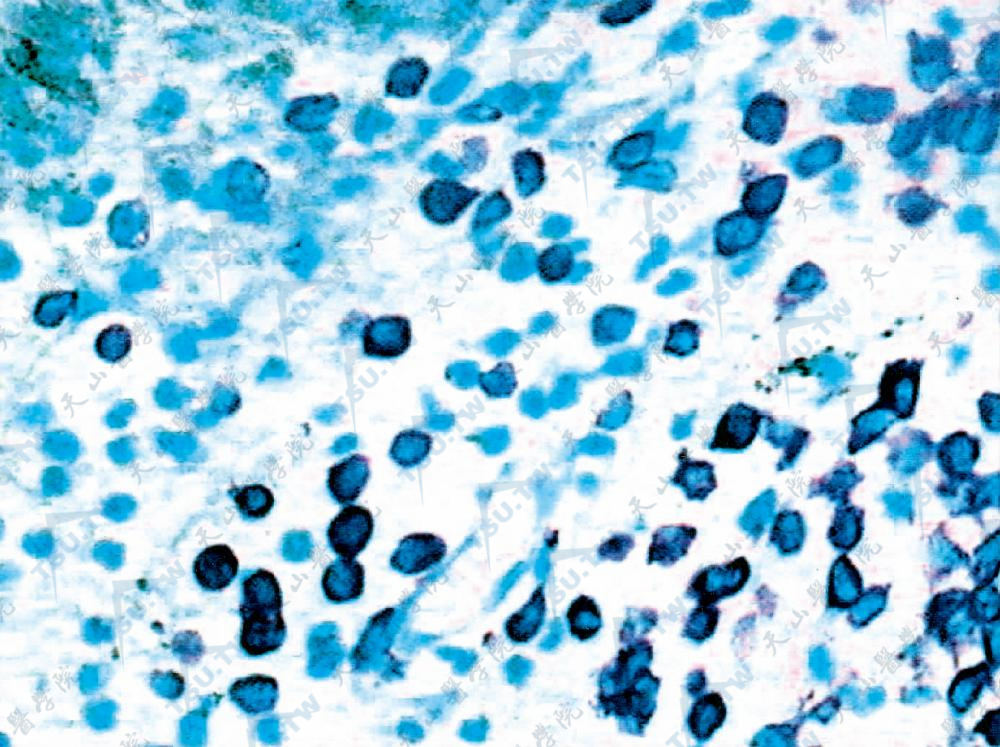 真皮内浸润细胞染色阳性（Giemsa染色×200）