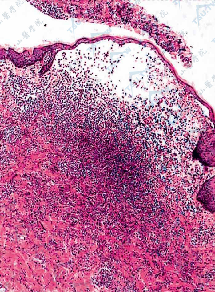 大疱性色素性荨麻疹，表皮下水疱，水疱内及真皮浅层大量炎细胞浸润