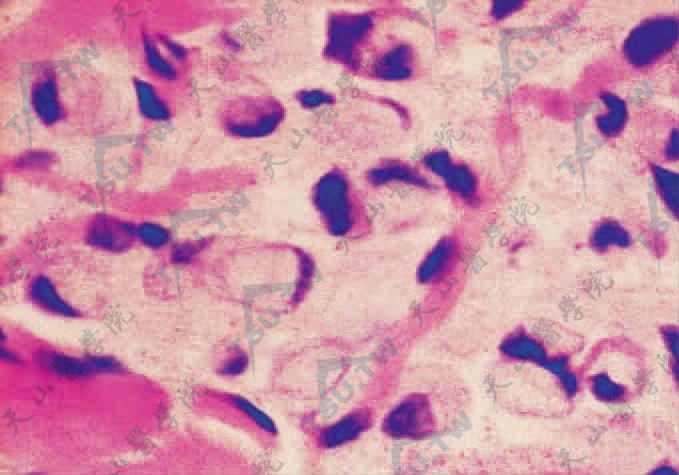 黏液样癌转移癌　癌细胞印戒状（HE染色×400）