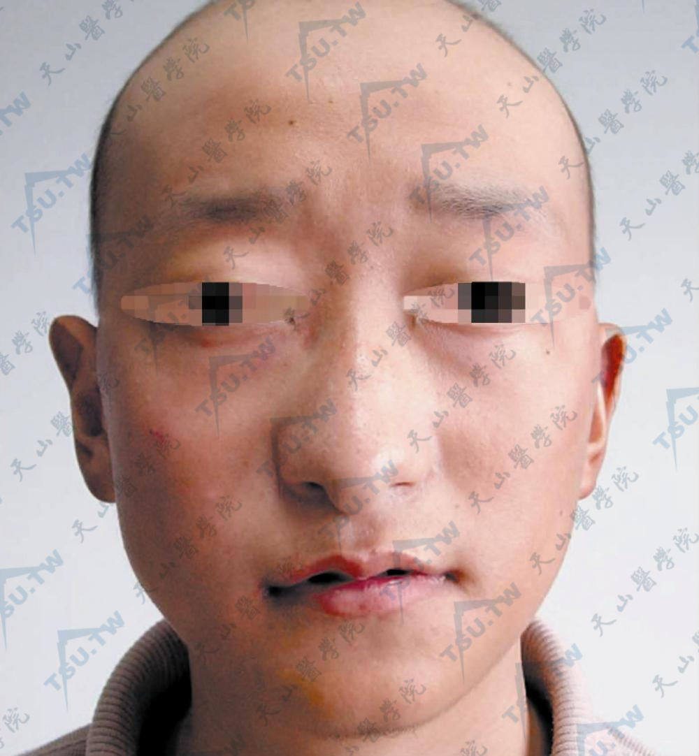 Langer-Giedion syndrome 眉毛外侧稀疏，梨形鼻，上唇薄，无胡须