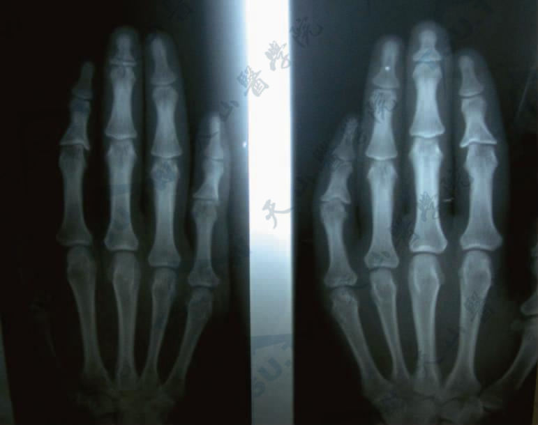Langer-Giedion syndrome 部分指骨骨骺呈锥形