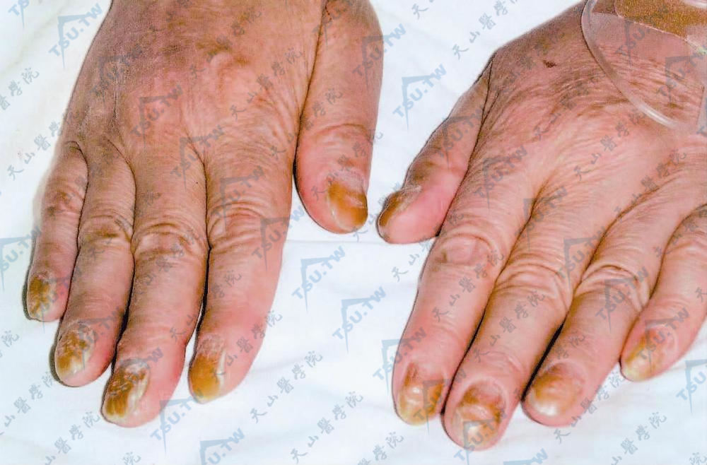 黄甲综合征（Yellow Nail Syndrome）