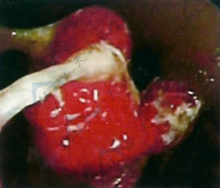 结肠脾曲有许多大小不等的息肉隆起