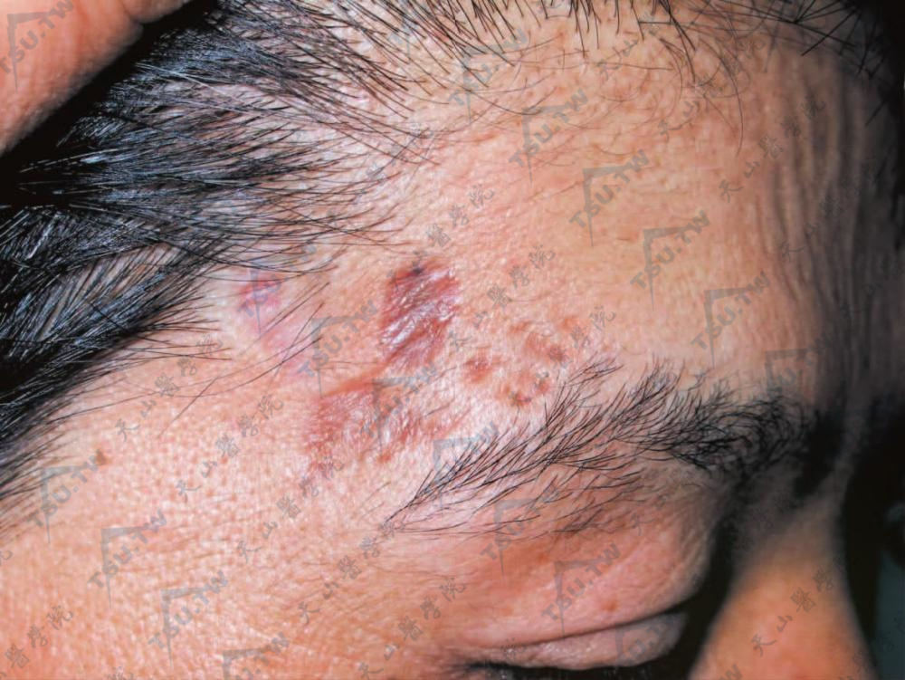 布朗尔综合征（Brauer Syndrome）患者右颞部瘢痕样斑疹