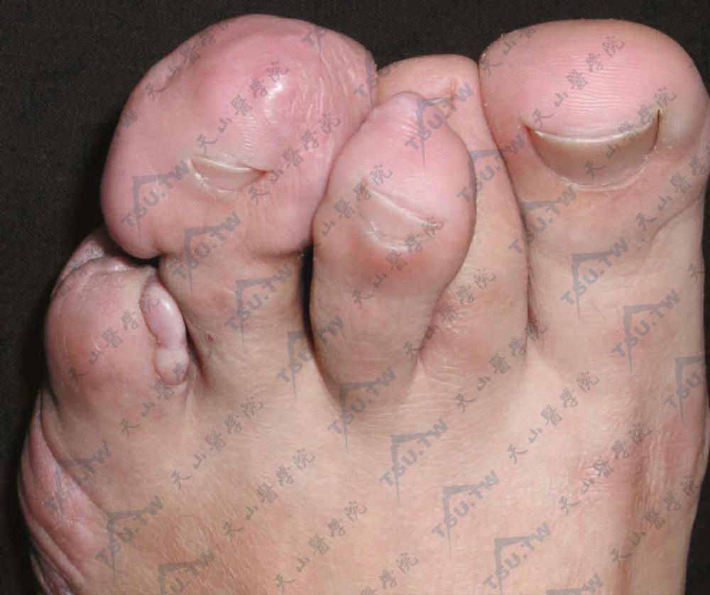 左足第4趾末节明显粗大，呈棒槌状，质硬。小拇趾内侧可见绿豆大小的质硬结节