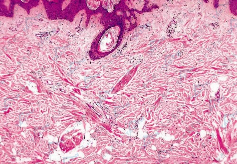 皮肤僵硬综合征（Stiff Skin Syndrome）组织病理