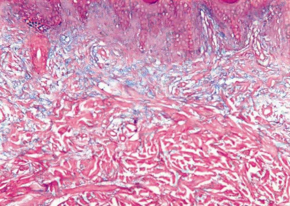 皮肤僵硬综合征（Stiff Skin Syndrome）皮肤组织病理学改变