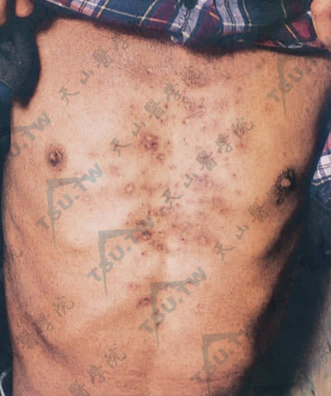 图1　胸前暗红色斑丘疹、小结节，有的中央结褐色痂，并有散在凹陷性瘢痕及色素沉着