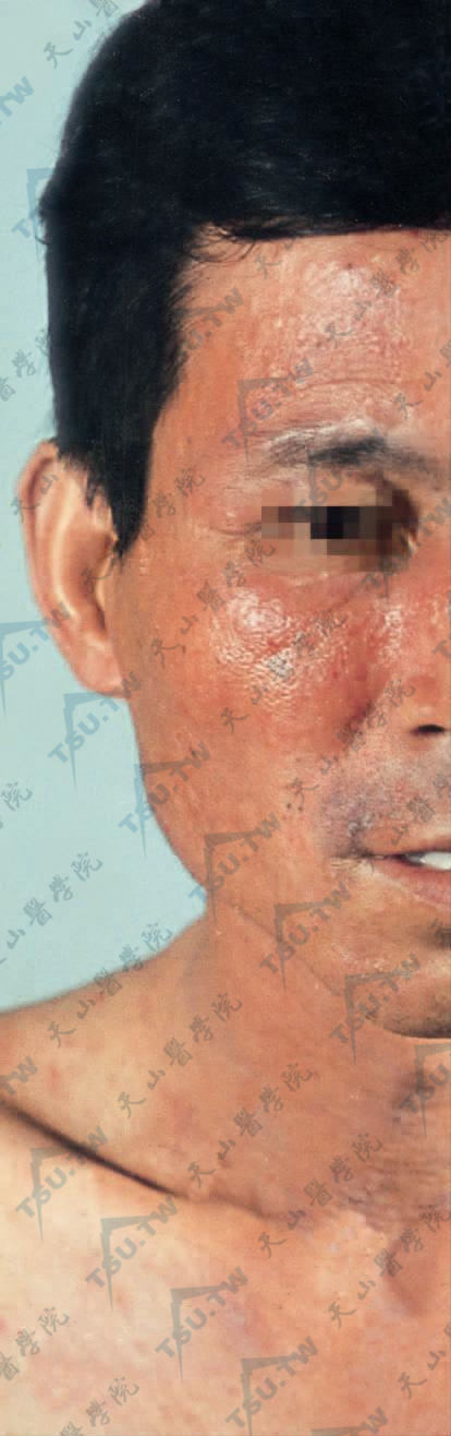 艾滋病患者面部弥漫性红斑，两侧鼻旁及鼻翼四周区域红色更深，伴少许脂性鳞屑