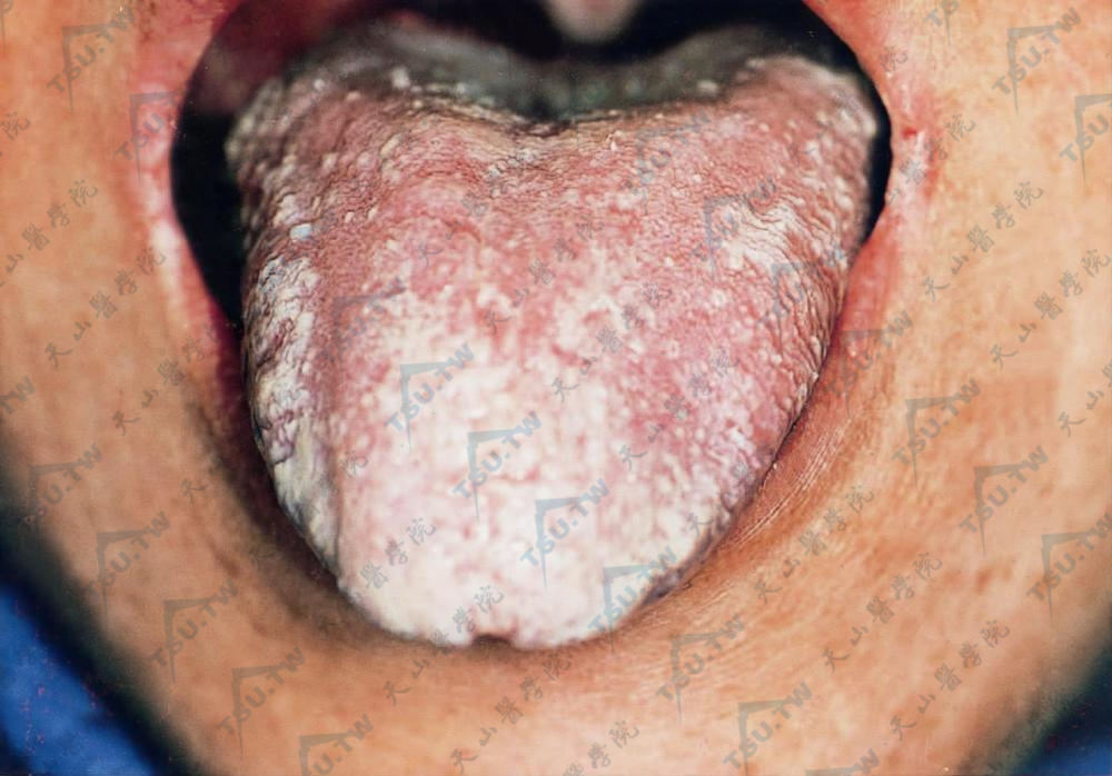 艾滋病毒感染者舌面布满白色伪膜，两侧口角炎，亦有白膜