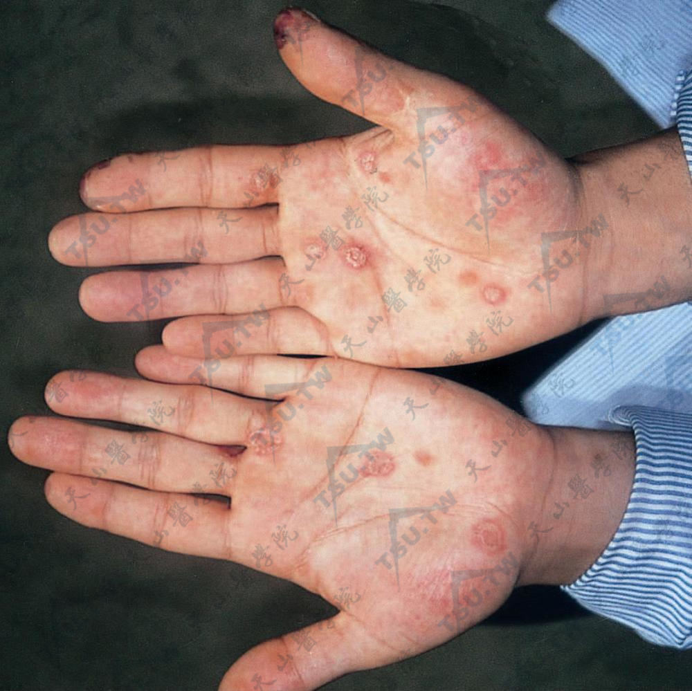 梅毒手部表现：两手掌圆形或椭圆形的玫瑰色丘疹，不互相融合，有白色鳞屑覆盖