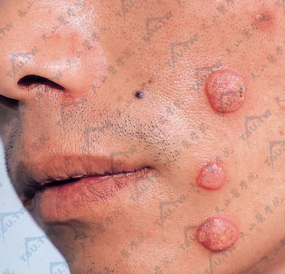 二期梅毒　面部大小不等暗红色结节和斑块