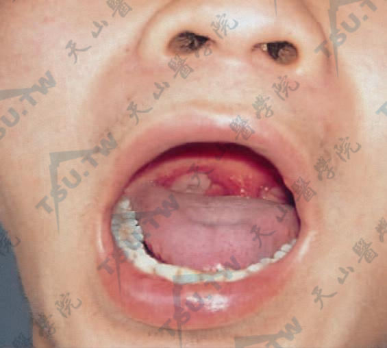 二期梅毒黏膜斑　咽部表面覆盖白色膜状物，扁桃体肿大
