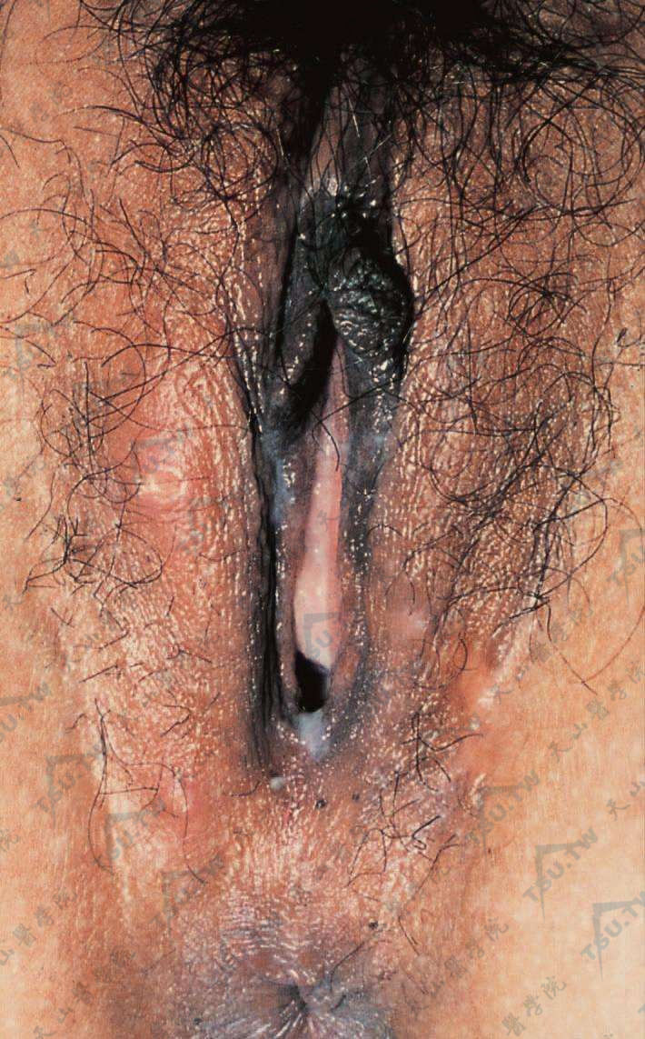 女性淋病　尿道症状不明显，常表现为淋菌性宫颈炎，脓性白带增多