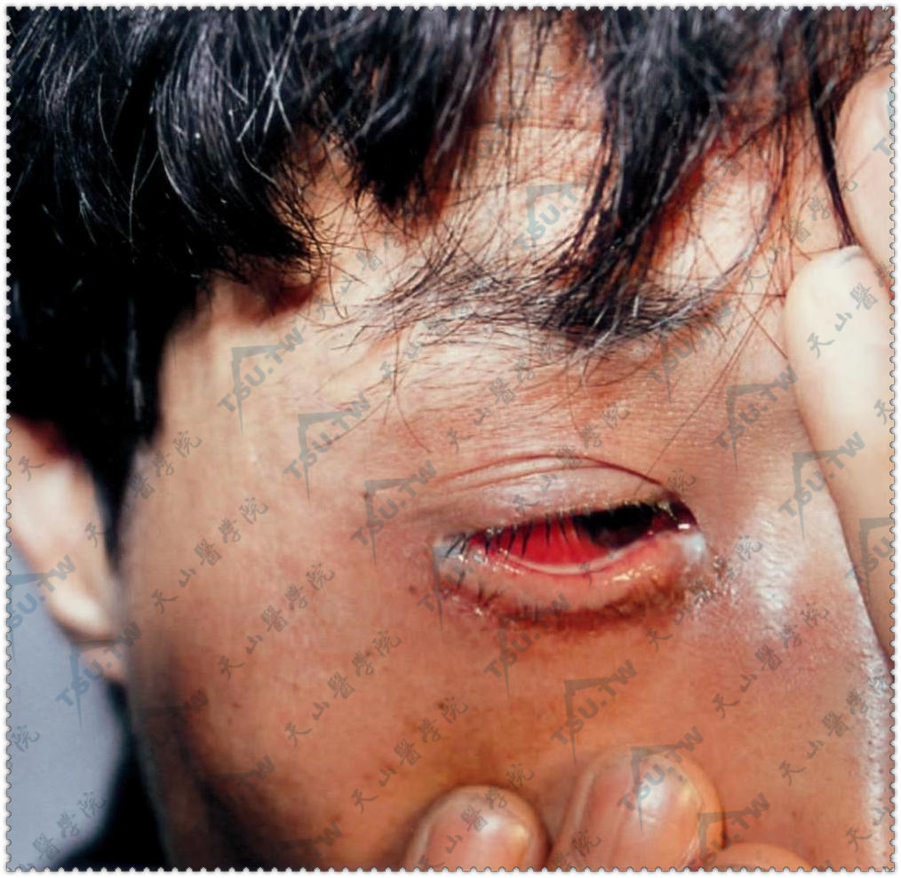 右眼淋菌性结膜炎　结膜充血发红，眼睑水肿，多量脓性分泌物
