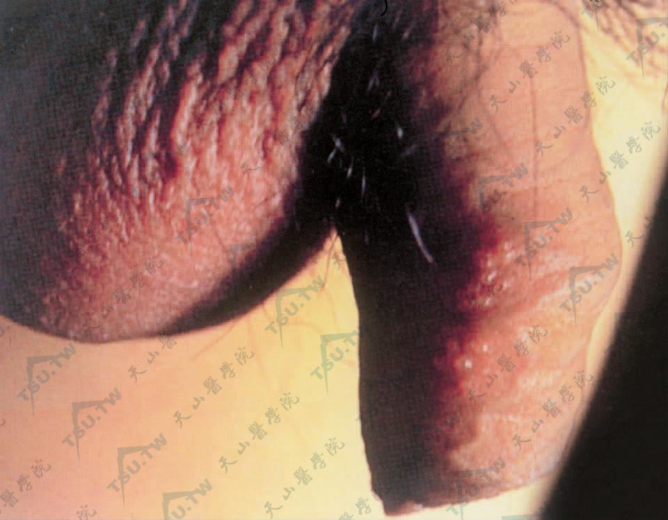 生殖器疱疹：病因、症状、诊断与治疗研究