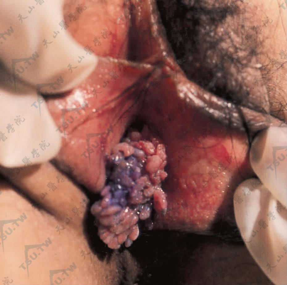 尖锐湿疣（阴道口）　阴道口突起乳头瘤样皮损，表面多数突起，形似一串葡萄