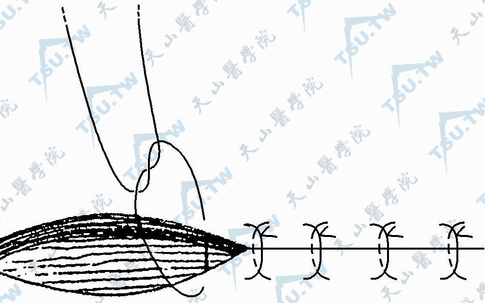 间断缝合