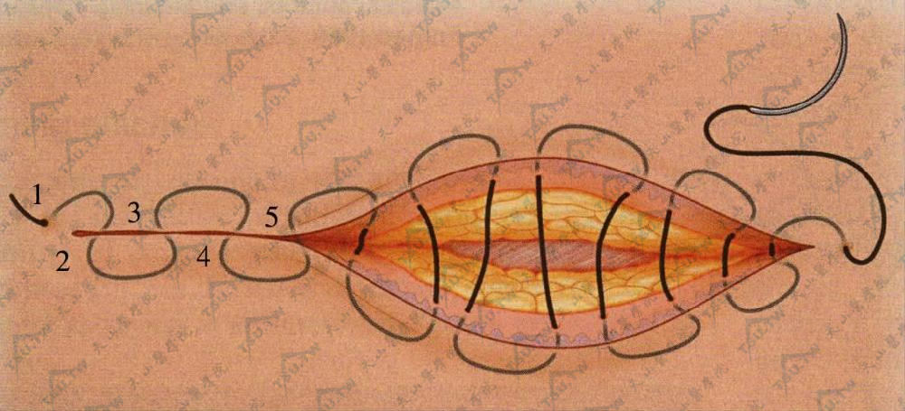 皮下连续缝合示意图图片