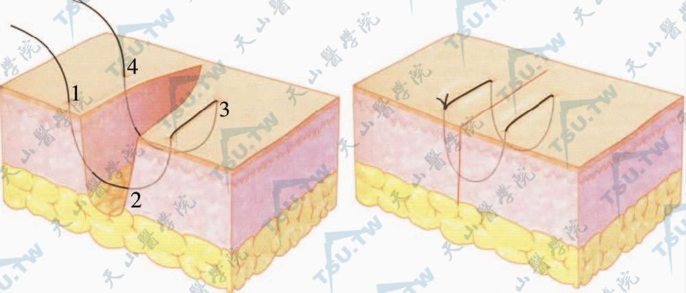 平行褥式缝合图片