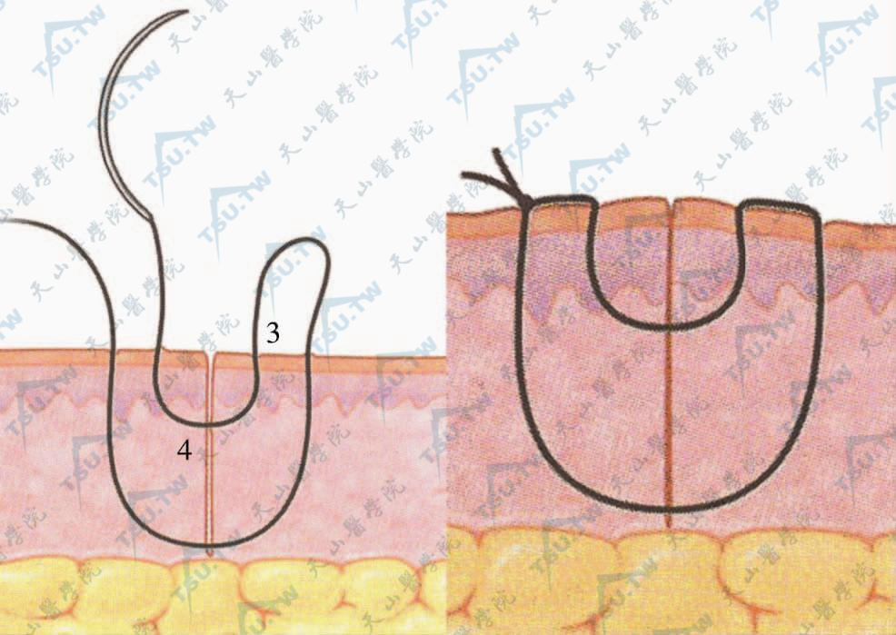 皮下连续缝合示意图图片