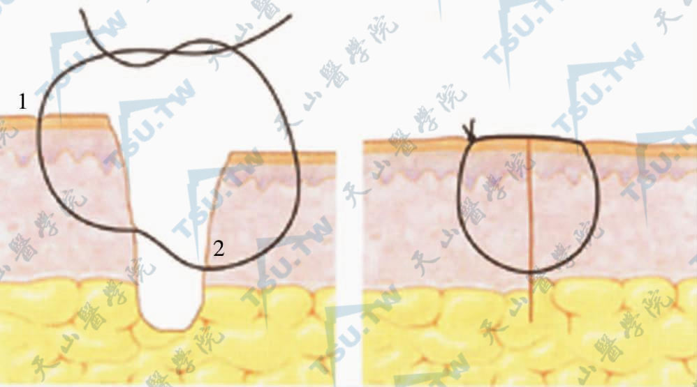 切口两侧高低不一缝合