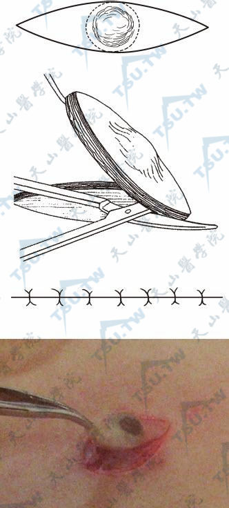 椭圆形切除缝合