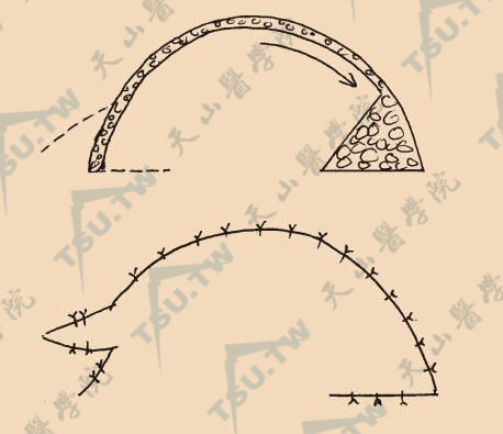 旋转皮瓣设计“Z”形切口