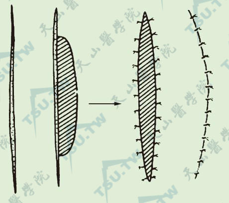 图C：双蒂滑行皮瓣（单侧）