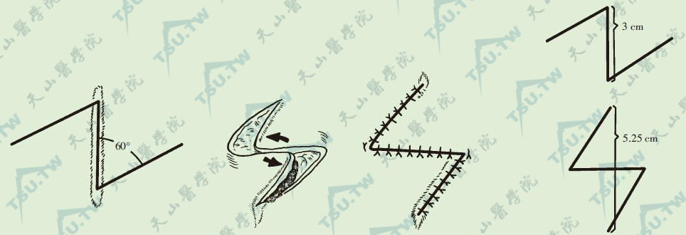 图B：“Z”成形臂的长及夹角大小与延长的关系