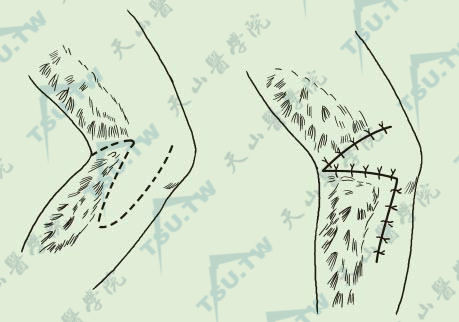 图C-1：鼻背部基底细胞上皮瘤切除“Z”皮瓣成形